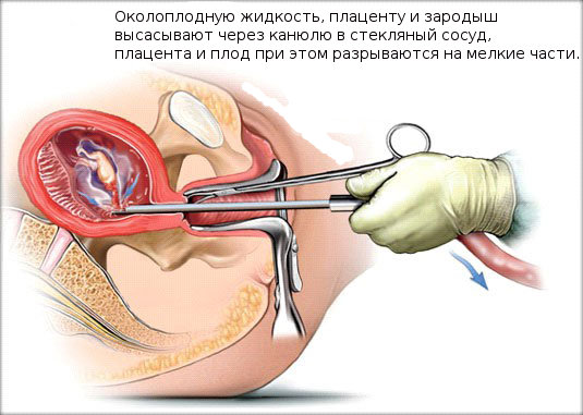 so-skolki-let-mozhno-delat-abort-im-8