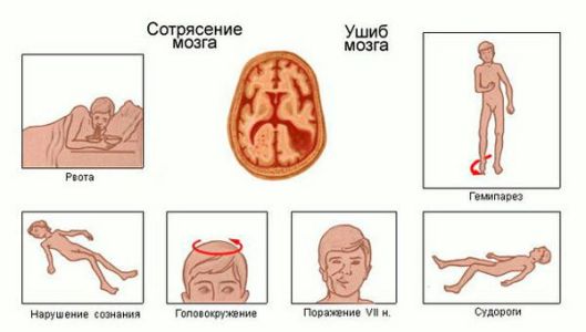 sotryasenie-golovnogo-mozga-stepen-tyazhesti-vreda-zdorovyu-im-1