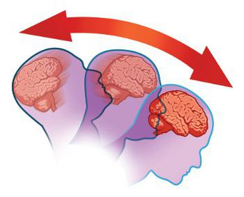 sotryasenie-golovnogo-mozga-stepen-tyazhesti-vreda-zdorovyu-im-5