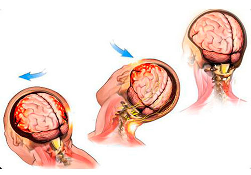 sotryasenie-golovnogo-mozga-stepen-tyazhesti-vreda-zdorovyu-im-8